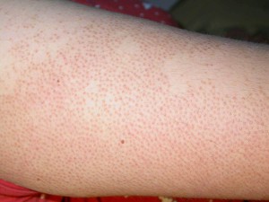 keratosis_pilaris_1_0303241