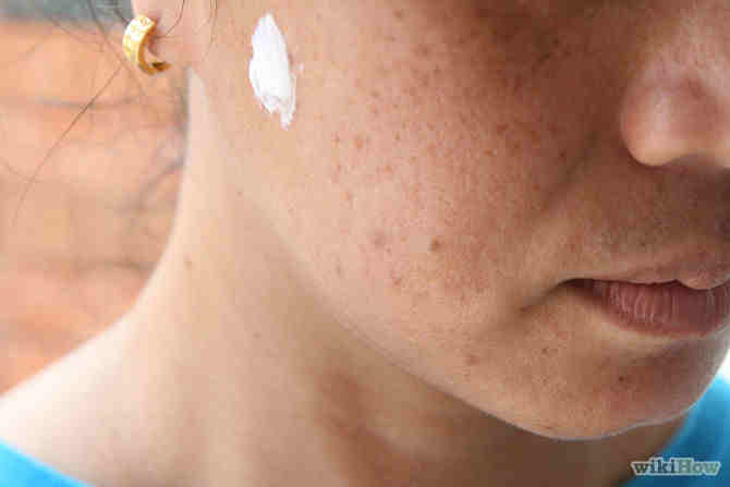 apply-toothpaste-on-blackheads