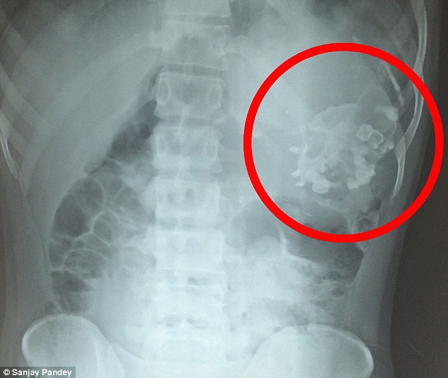 Tvíburi drengsins sést hér greinilega á röntgenmynd