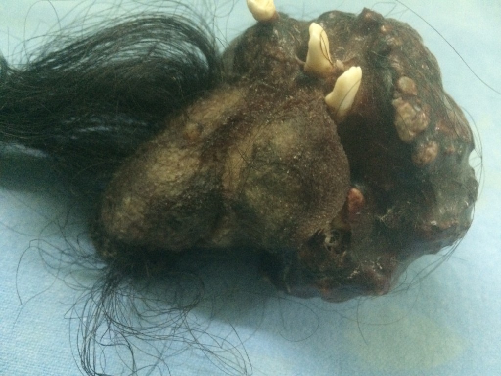 Þetta olli verkjunum: Nærmynd af tvíbura drengsins