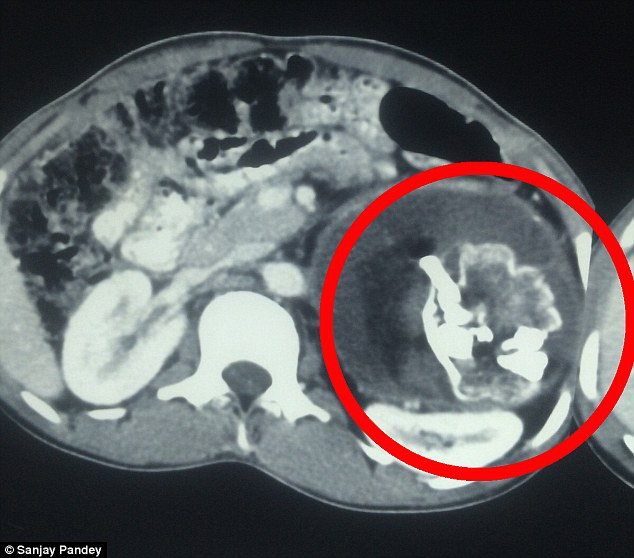 Hér má sjá nákvæma sneiðmyndatöku sem sýnir staðsetningu tvíburans 